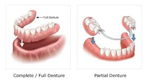 Partials-Dentures